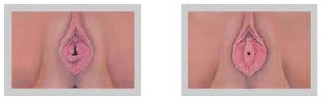 Before-after-hymenoplasty
